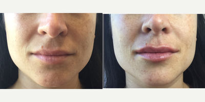 Dermal Fillers before and after photo