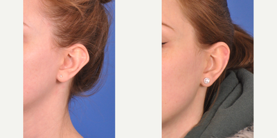 Ear Surgery before and after photo
