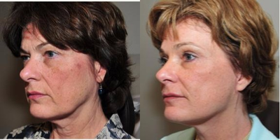 Facelift before and after photo