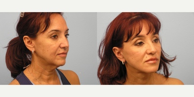 Facelift before and after photo