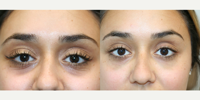 Restylane before and after photo