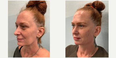 Botox before and after photo