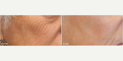 CO2 Laser before and after photo