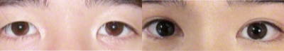 Double Eyelid Surgery before and after photo