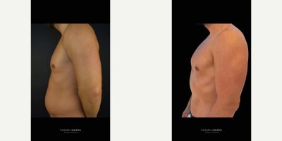 Liposuction before and after photo