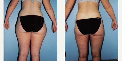Tumescent Liposuction before and after photo