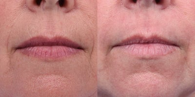 Dermabrasion before and after photo