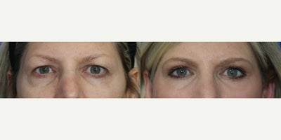 Eyelid Surgery before and after photo