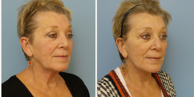 Facelift before and after photo