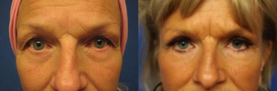 Eyelid Surgery before and after photo