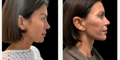 Facelift before and after photo