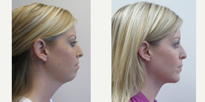 Genioplasty before and after photo