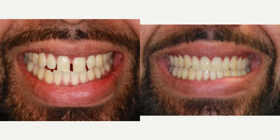 Invisalign before and after photo