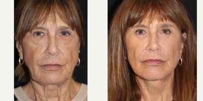 Neck Lift before and after photo