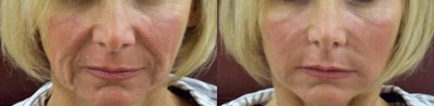 Radiesse before and after photo