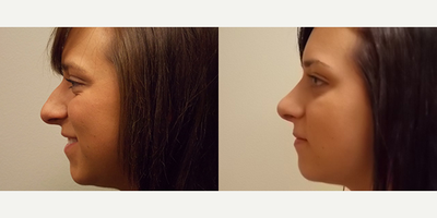 Rhinoplasty before and after photo