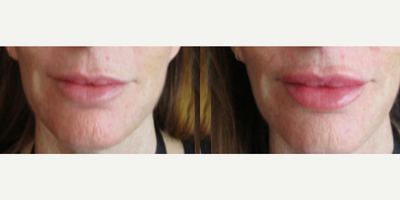 Dermal Fillers before and after photo