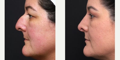 Eyelid Surgery before and after photo
