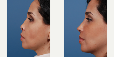 Revision Rhinoplasty before and after photo