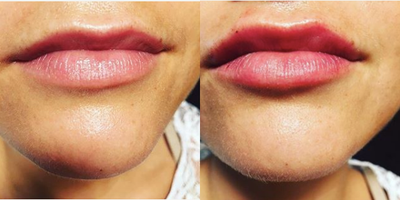 Vollure before and after photo