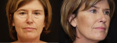 Belotero before and after photo