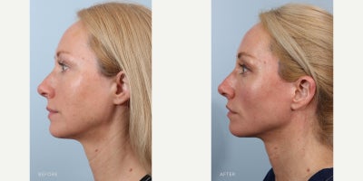 Eyelid Surgery before and after photo