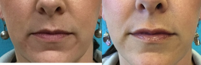 Juvederm before and after photo