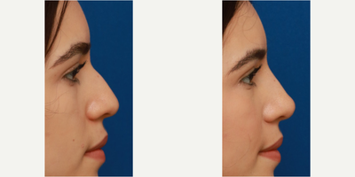 Nonsurgical Nose Job before and after photo