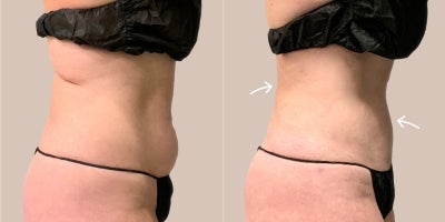 AirSculpt before and after photo