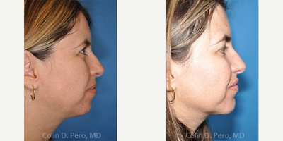Chin Implant before and after photo