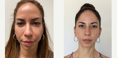 Collagen Injection before and after photo