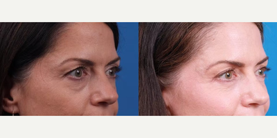 Eyelid Surgery before and after photo