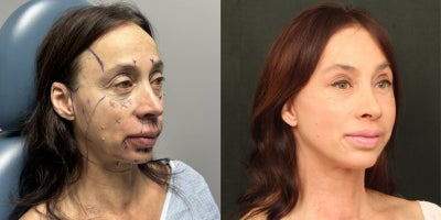 Facelift before and after photo