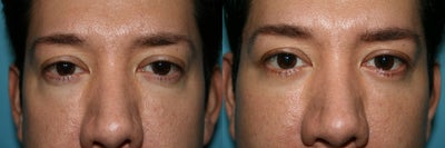 Eyelid Surgery before and after photo