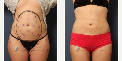 Liposuction before and after photo