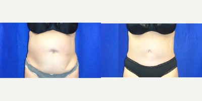 Tummy Tuck before and after photo