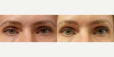 Upneeq before and after photo