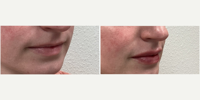 Juvederm before and after photo