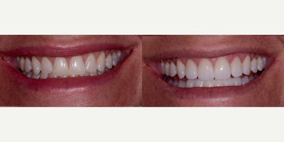 Porcelain Veneers before and after photo