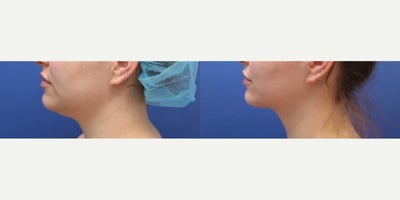 Tumescent Liposuction before and after photo