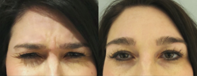 Botox before and after photo