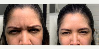 Botox before and after photo