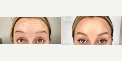Botox before and after photo