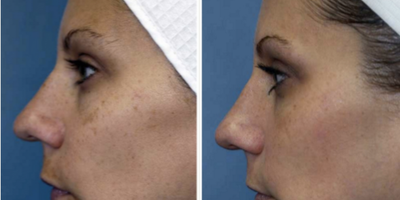 Clear and Brilliant before and after photo