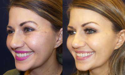Botox before and after photo