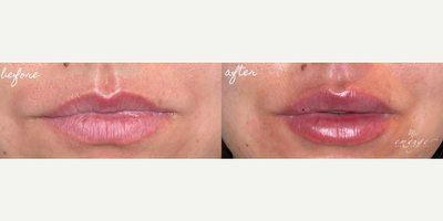 Dermal Fillers before and after photo