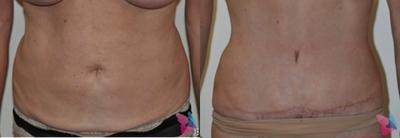 Tummy Tuck before and after photo