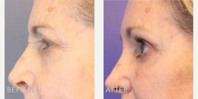 Brow Lift before and after photo