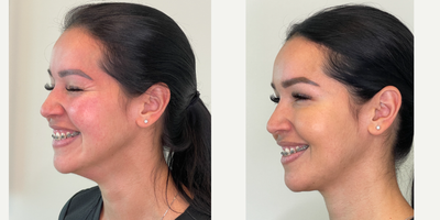 Dysport before and after photo