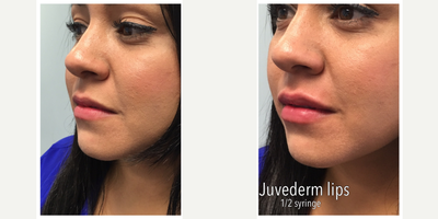 Juvederm before and after photo